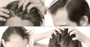 Scalp Conditions for Proper Hair Care