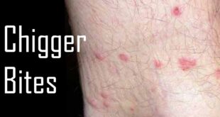 How to Treat Chigger Bites at Home