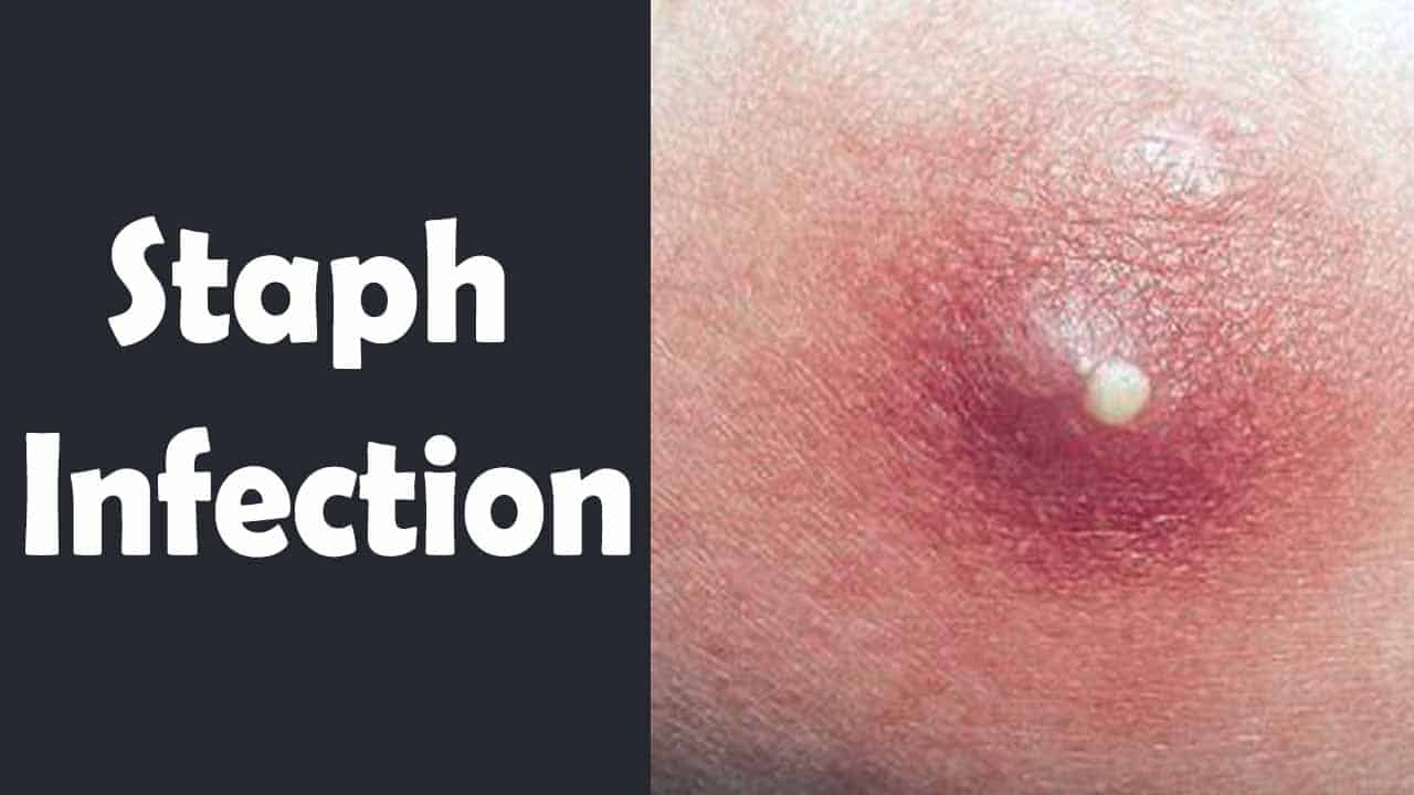 Staph Infection