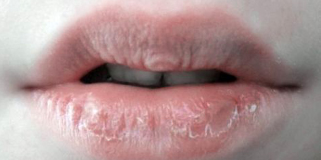 Best Home Remedies for Chapped Lips