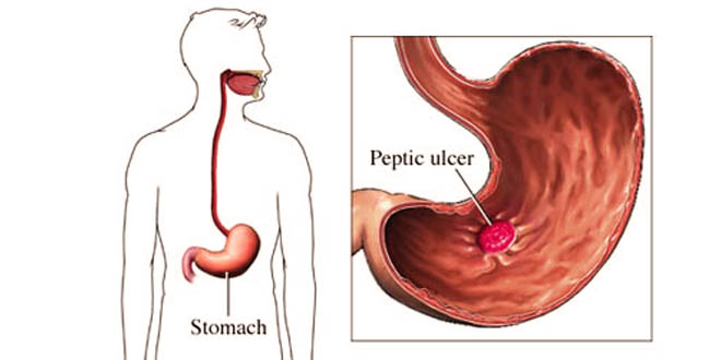 Common Causes that Lead to Peptic Ulcers