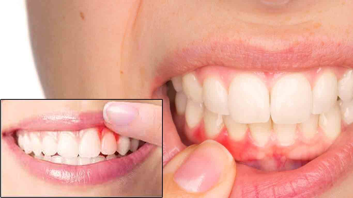 How to cure gum disease without a dentist